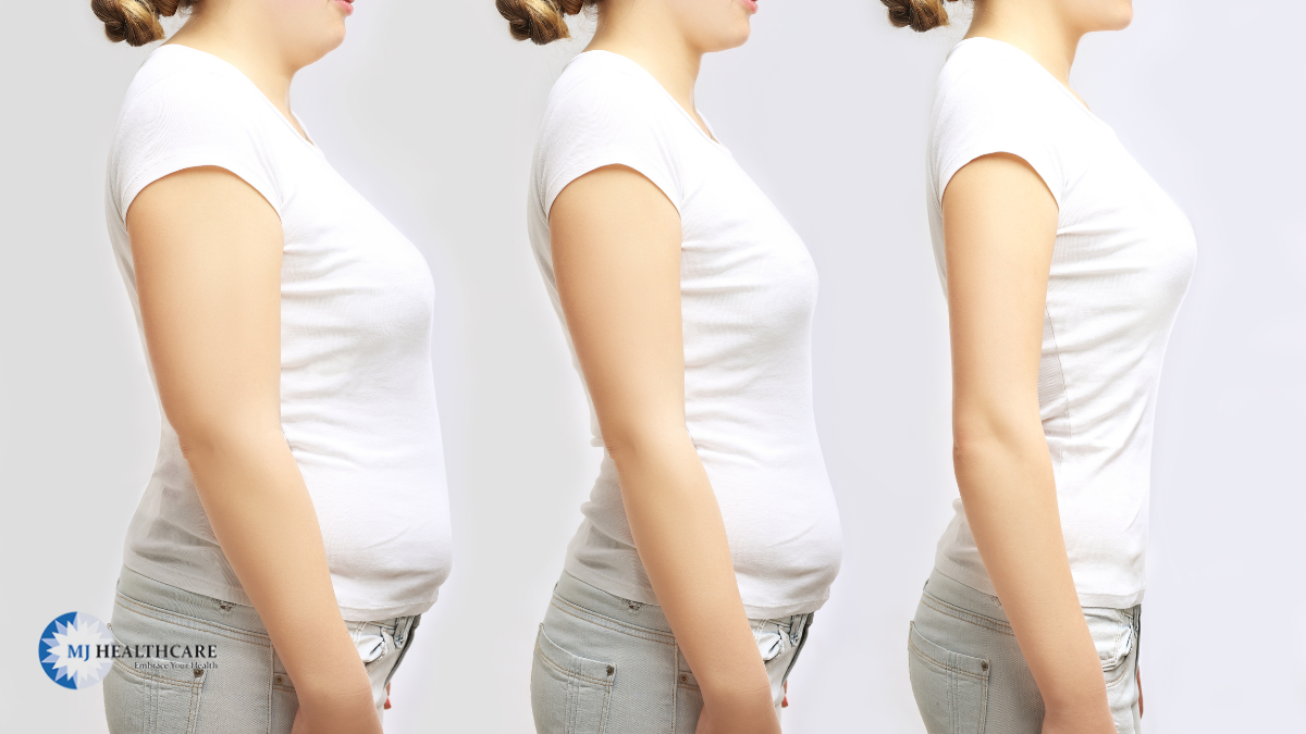 Post: Is Undergoing Weight Loss Surgery Really Beneficial to Attain the Anticipated Result of Getting Fit Again?